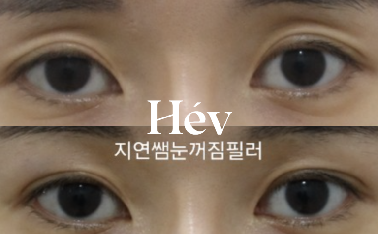 Review of 2cc Filler Procedure for Sunken Upper Eyelids / Eye Hollows.