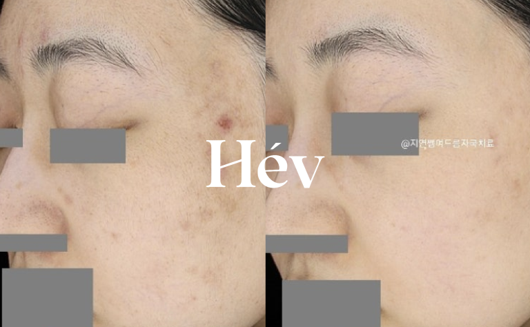 Dermatology clinic specializing in acne scars.
