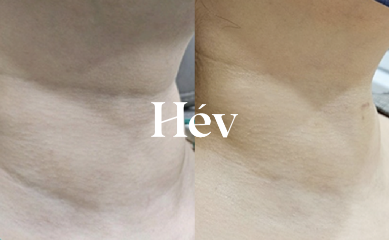 Neck wrinkle treatment with filler, Rejuran, and Skin Botox / Double chin Ulthera lifting procedure.