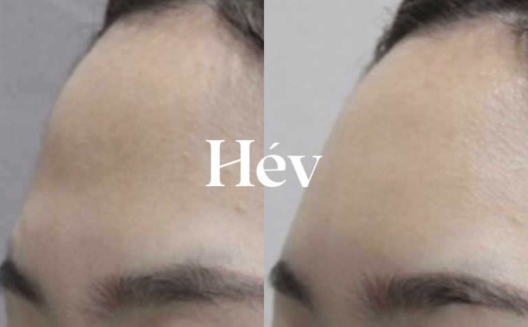 A bride-to-be’s natural-looking forehead filler review