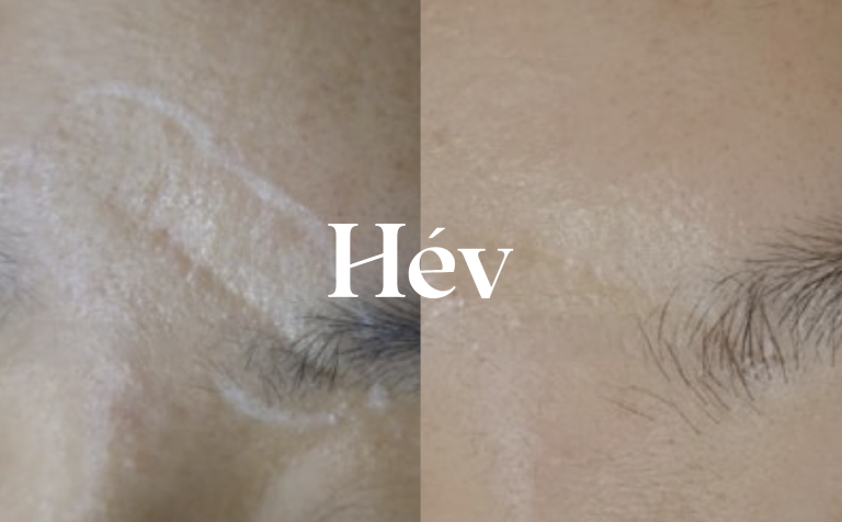 CureJet & Juvederm Voluma (CureVoluma) forehead scar laser treatment review.