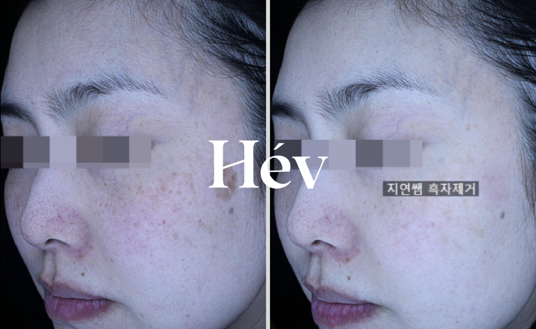How to clear your skin with a laser to remove freckles and blackheads.