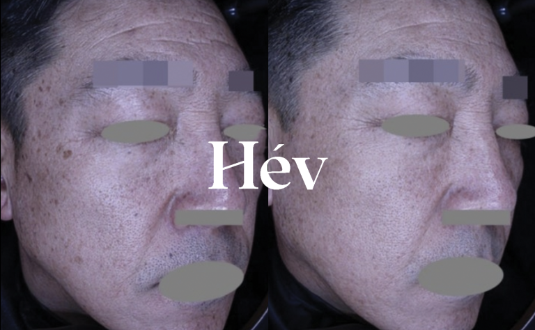 Juvederm Voluma for nasolabial folds in a man in his 50s + pigmentation and blemish treatment with toning laser – Treatment Review