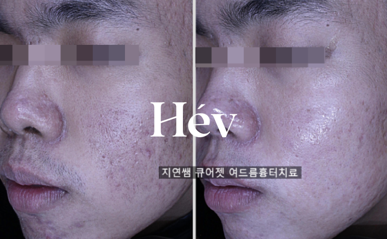 Curejet Juvelook Kidocter thermal suture fine acne scar treatment effect and before and after treatment.