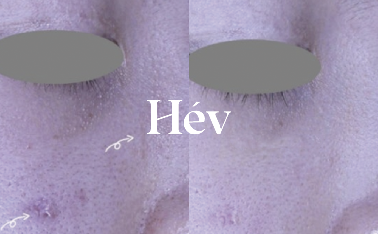 CureB-LOOK (CureJet JuveLook Scar Treatment) – 6-Month Follow-Up