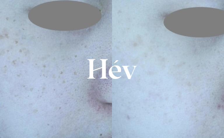 Laser treatment for melasma and pigmentation to achieve clear, radiant skin for brides-to-be –