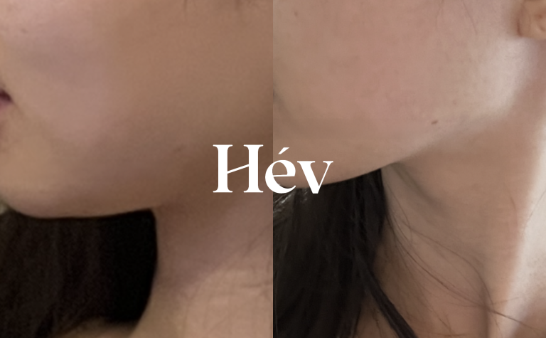 Sparta Oligio 300-Shot & Ulthera Combination Treatment Review