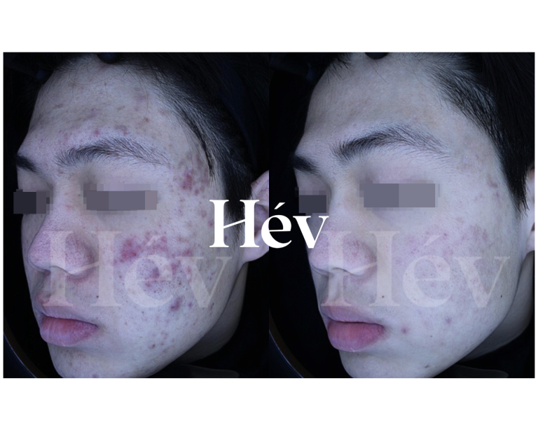 Adult Acne Scar Laser Treatment Review