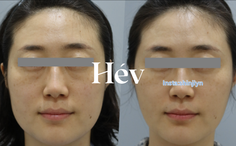 Non-surgical facial contouring: correction of sunken under-eyes and peanut-shaped cheeks.