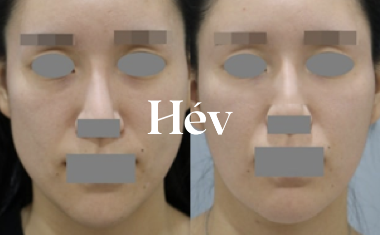 Juvederm Voluma for peanut-shaped face contour correction, Ulthera, InMode Violet contour injections, and jawline Botox – complete collection.