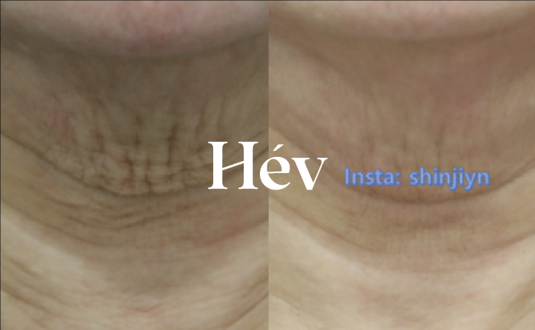 Neck Wrinkle Lifting Method! Laser, Filler, Radius Skin Botox, What Should I Do?