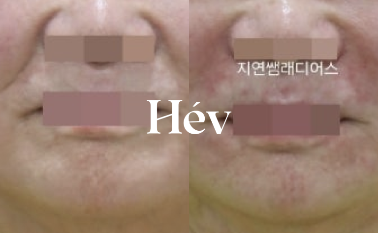 Marionette [Nasolabial Fold Eraser] Radiesse Skin Booster Complete Guide.