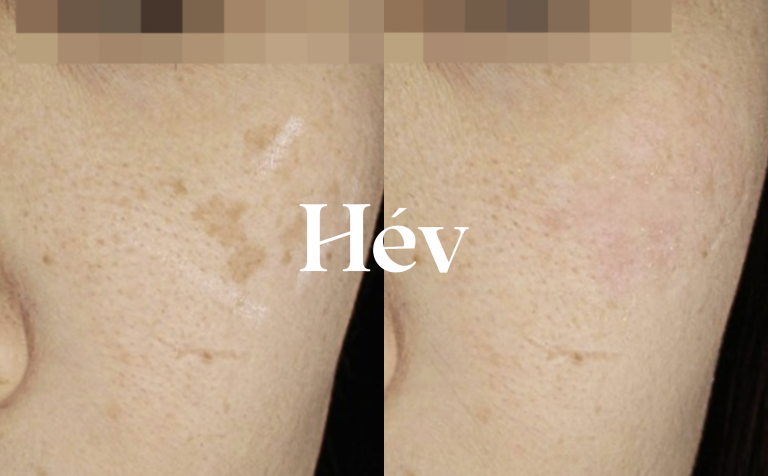Top 3 most frequently asked questions about laser removal of 5 dark spots: