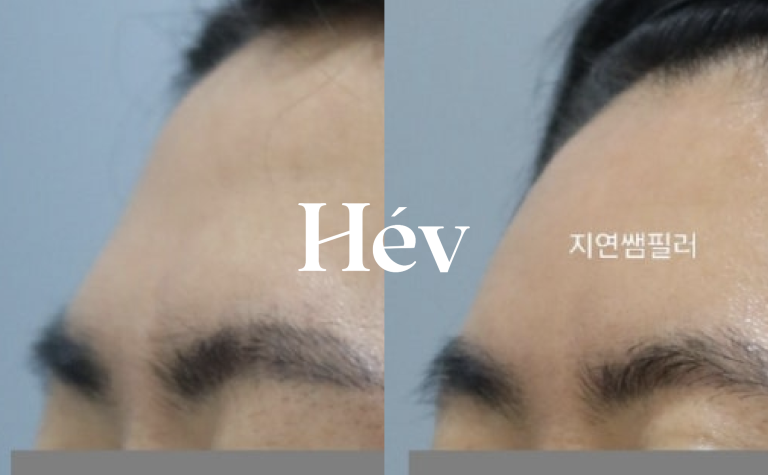 Male forehead and glabella wrinkles – Filler and Botox procedure with 1 cc, 2 cc, and 3 cc.