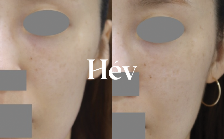 Three-month follow-up after Juvederm Voluma treatment for nasolabial folds, front cheek hollowness, and side cheek hollowness.