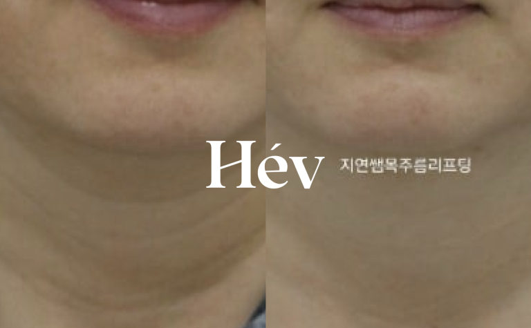 Effects of neck wrinkle lifting with Belotero filler, Radiesse, Juvederm, and skin Botox.