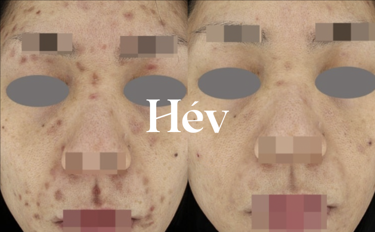 Excavated acne scar treatment: Fractional laser + CureJet + Juvederm Voluma.