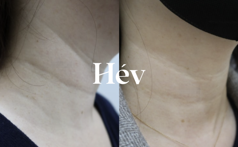 Review of neck wrinkle filler using Belotero Soft 2cc.