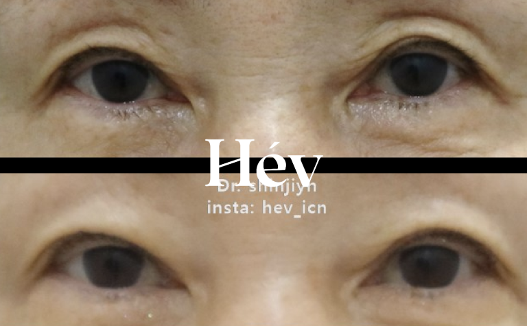 Dermatology clinics that specialize in eyelid fillers! What about dosage? Effects? Side effects?