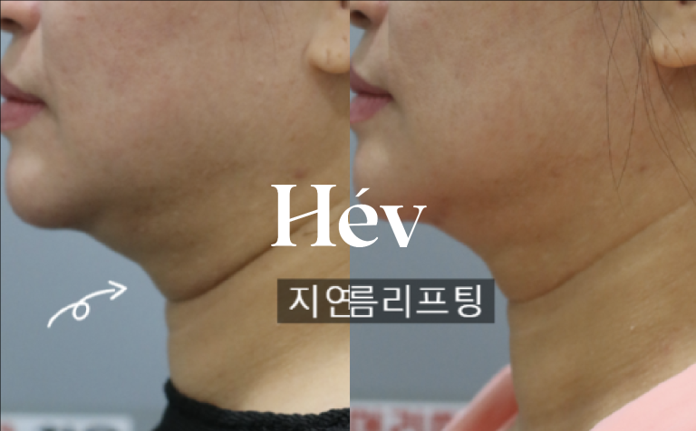 Neck wrinkles, double chin, Ulthera, Belotero filler 2 cc, and skin Botox.
