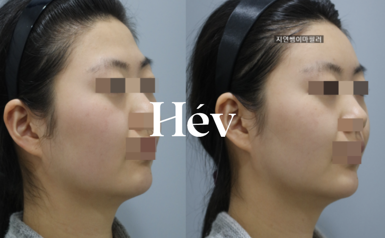 Forehead filler at a dermatology clinic – Juvederm Voluma, Radiesse – for a neat and elegant look, suitable for announcers, flight attendants, and classy appearances.