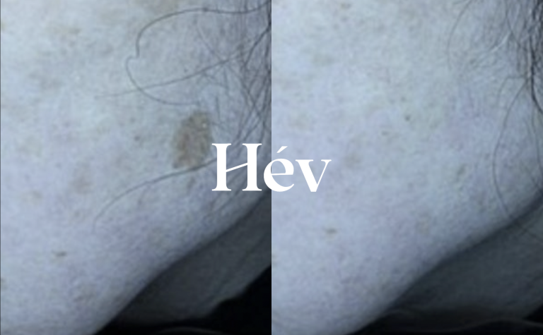 Seborrheic keratosis removal laser treatment –