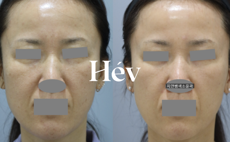 Dermatology treatment for nasolabial folds, sunken front cheeks, and Indian band – Juvederm Voluma filler procedure.