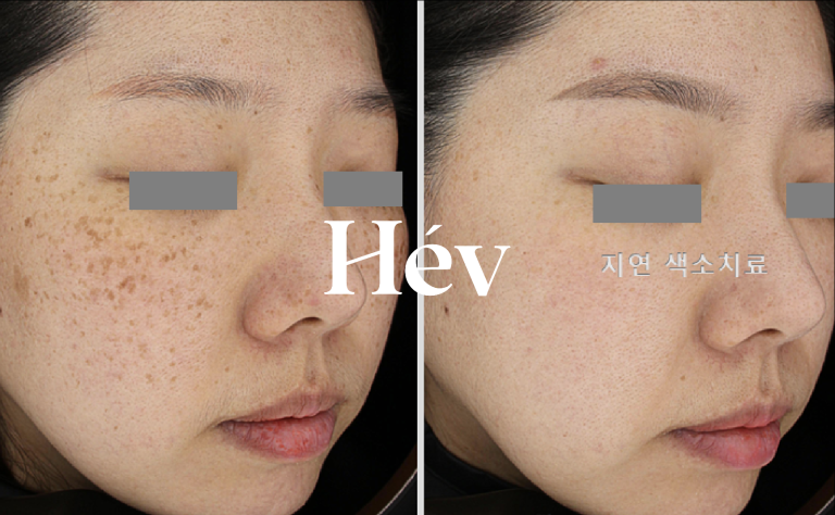 Why did melasma, dark spots, and blemishes not improve with laser treatment or Pico Toning?!
