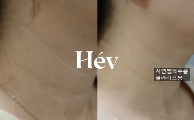 Follow-up after re-treatment of neck wrinkles at 1 year and 2 years: Belotero filler and skin Botox.