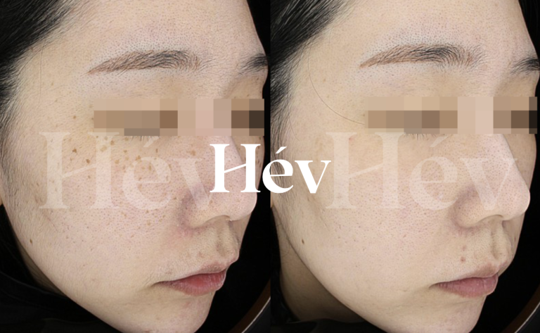 Let’s solve it with pigment treatment, photo, or Starwalker.