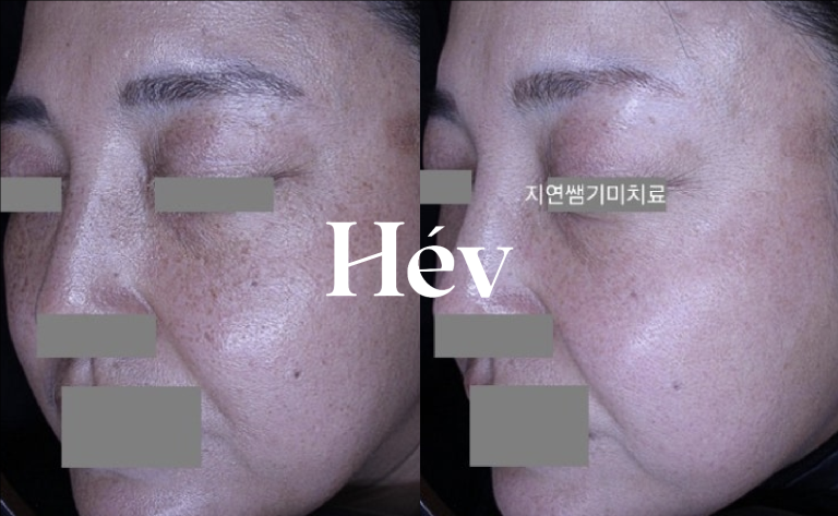 Before and after 10 sessions of Pico Toning Laser for freckles, spots, and pigmentation.