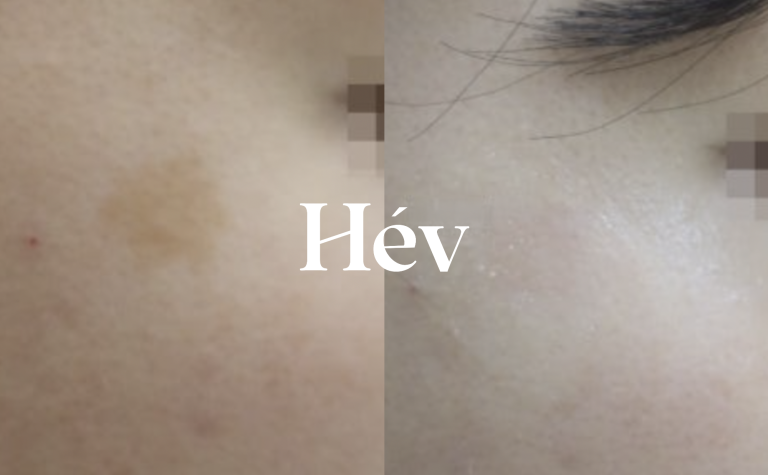 Incheon Dermatology Black Spot Removal Laser Treatment–