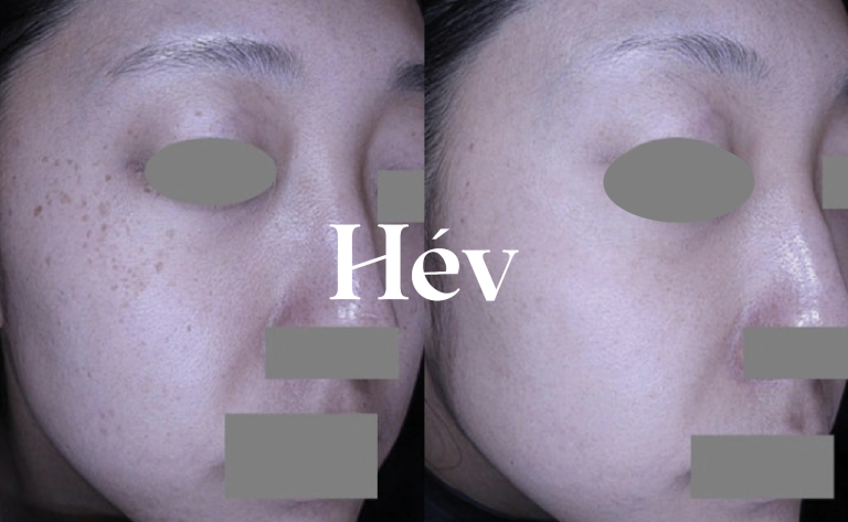 Pigmentation and blemish laser treatment & skincare for brides-to-be