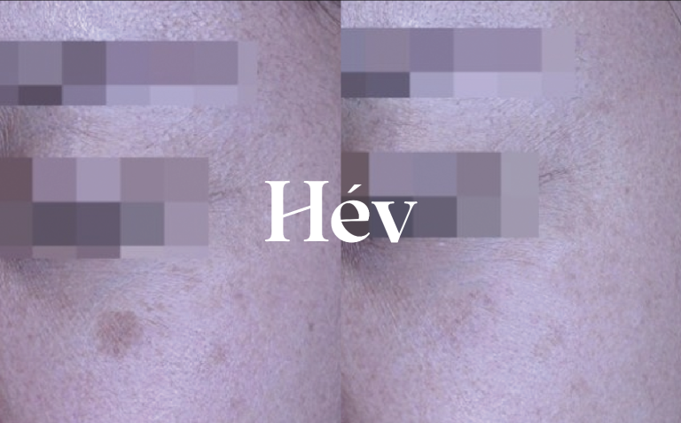 Recommended pigmentation-removal lasers and treatment reviews