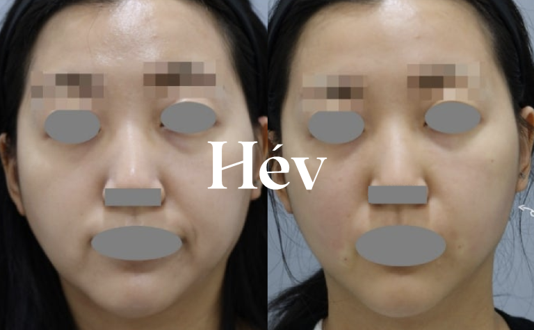 [Full Face] Mid-face, nasolabial fold, and lateral cheek filler + Ultherapy, chin Botox, and jawline contouring