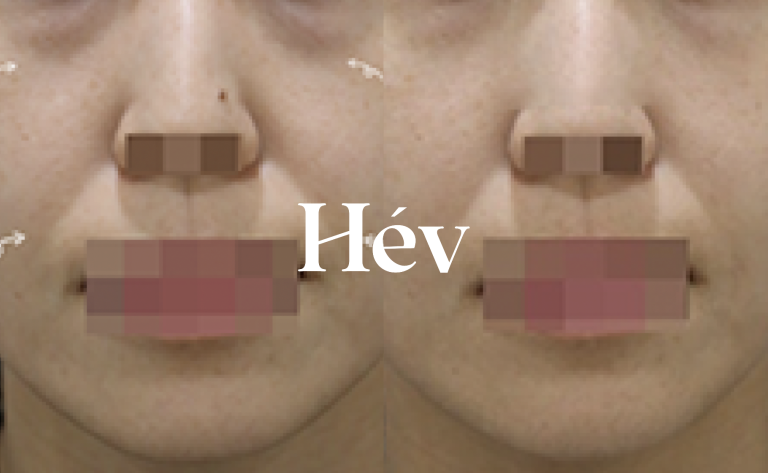 Nasolabial Fold Sculptra, Juvederm Voluma, and Nasolabial Fold Filler Procedure: How It’s Done, Immediate Post-Procedure Swelling & Post-Procedure Massage Method