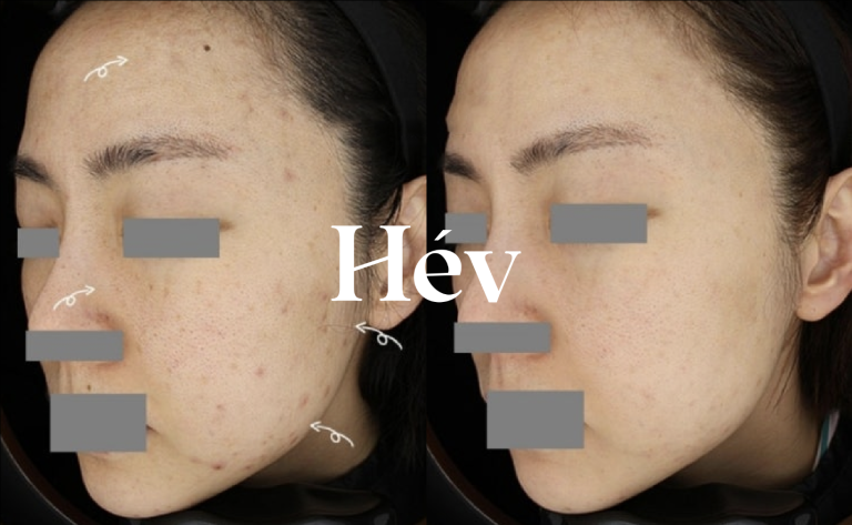 Laser treatment for adult female acne scars, marks, and pigmentation spots