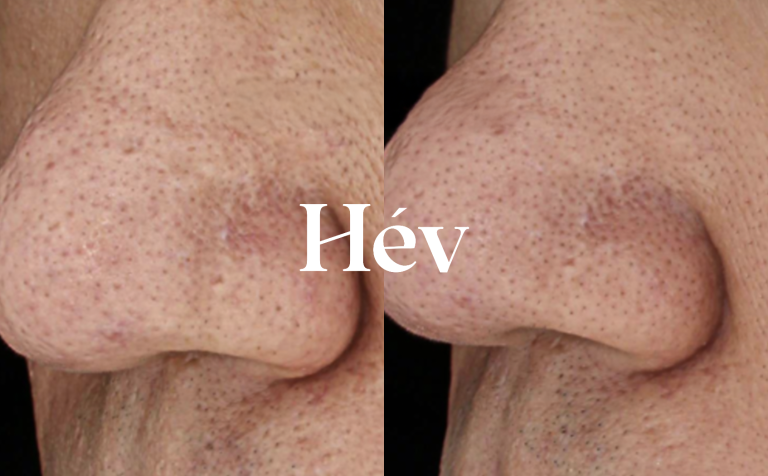 CureJet treatment for acne-related nasal hypertrophic scars and temple nail marks.