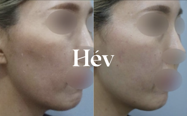 Sunken side cheeks / sunken front cheeks / Juvederm volume? Side cheek filler or front cheek filler?