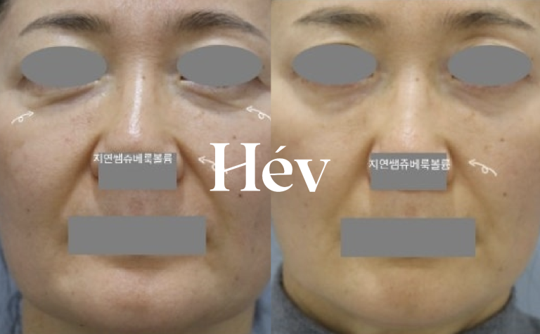 “Juvederm Voluma for under-eyes and nasolabial folds – 6 syringes & long-term results at 1, 2, 3, and 6 months.