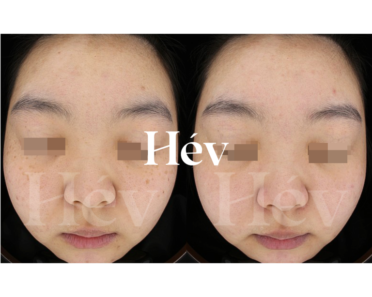 Skin Booster + Pigmentation Treatment 10-session Review
