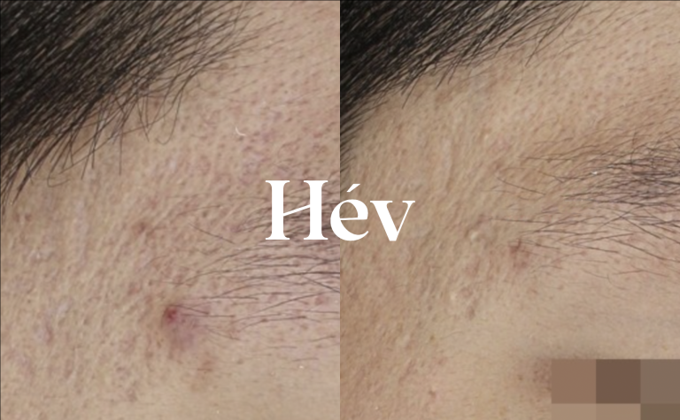 CureJet + Juvederm Voluma forehead and temple acne scar treatment review.