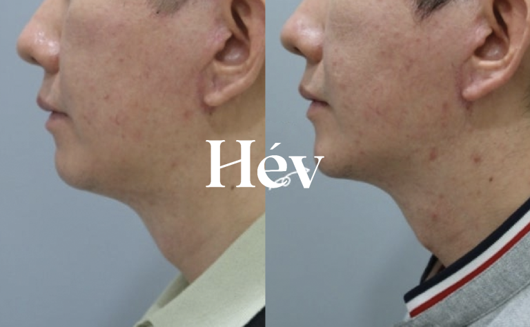 The Importance of 1cc Chin Filler for Men with Protruding Mouth or Receding Chin — A Non-Surgical Alternative to Chin Implant Surgery.