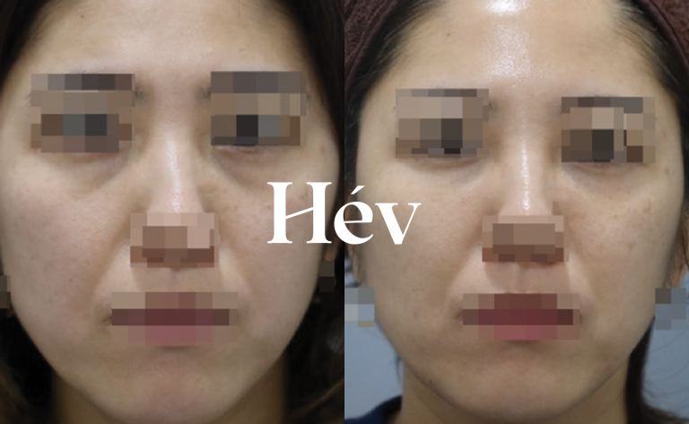 Review: 2cc of Mid-Face Filler & Under-Eye Hollow Filler