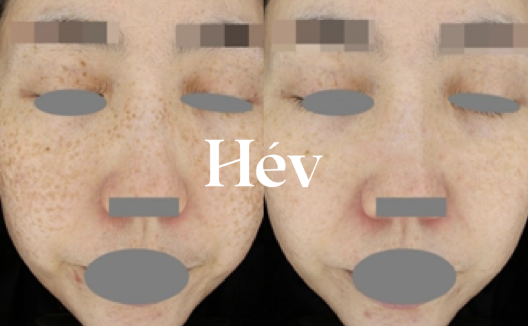 Laser Pico Toning Treatment for Melasma, Blemishes, and Dark Spots