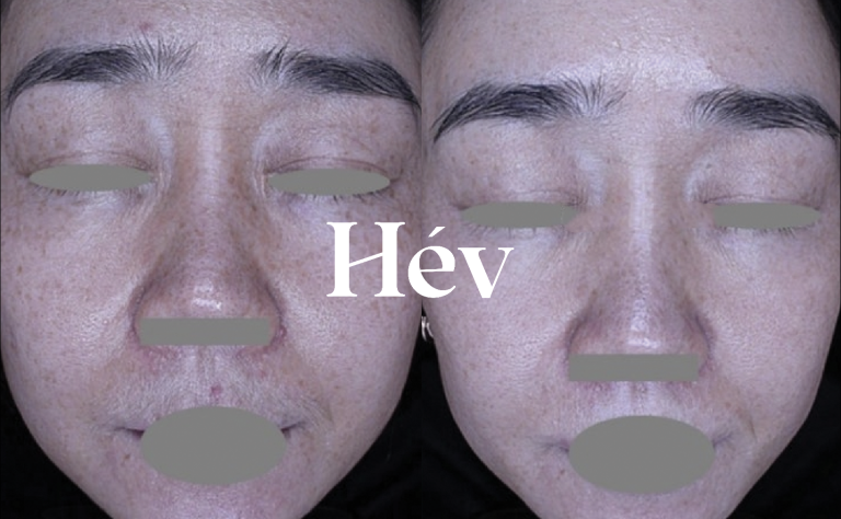 Laser treatment for melasma, blemishes, and freckles. Survived the peak of summer well!