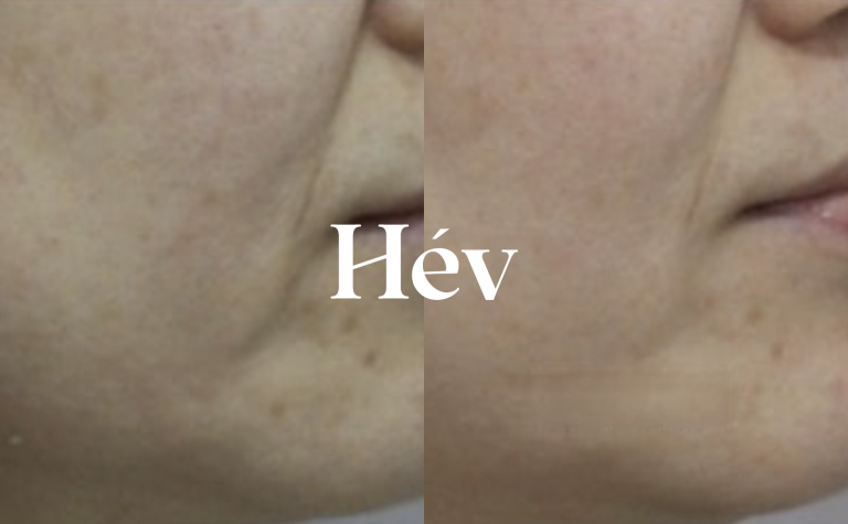 Ulthera effects and treatment interval (How many shots are needed?)