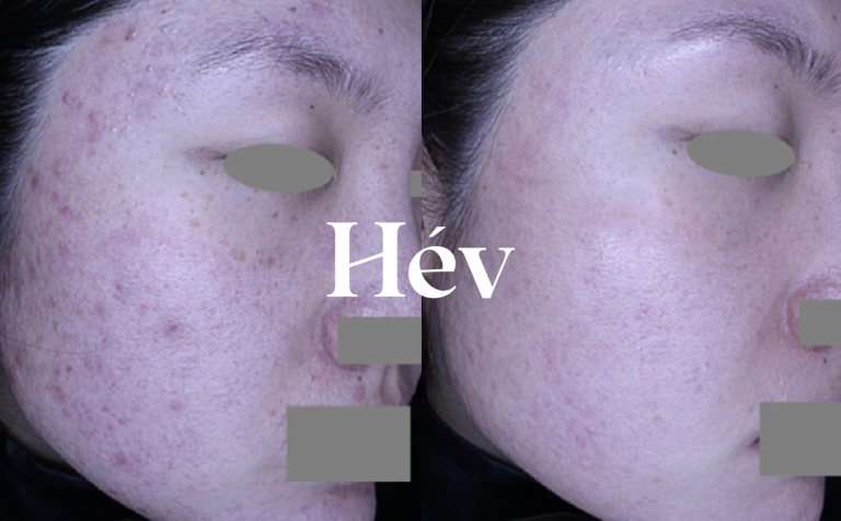 Laser treatment for acne scars, marks, and traces in students and adults.