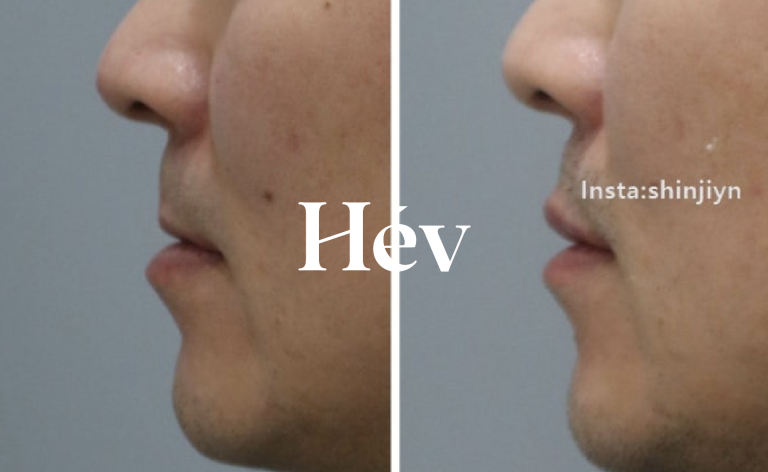 Men’s philtrum shortening & lip filler (1 cc) — how to improve lip dryness and flaking!