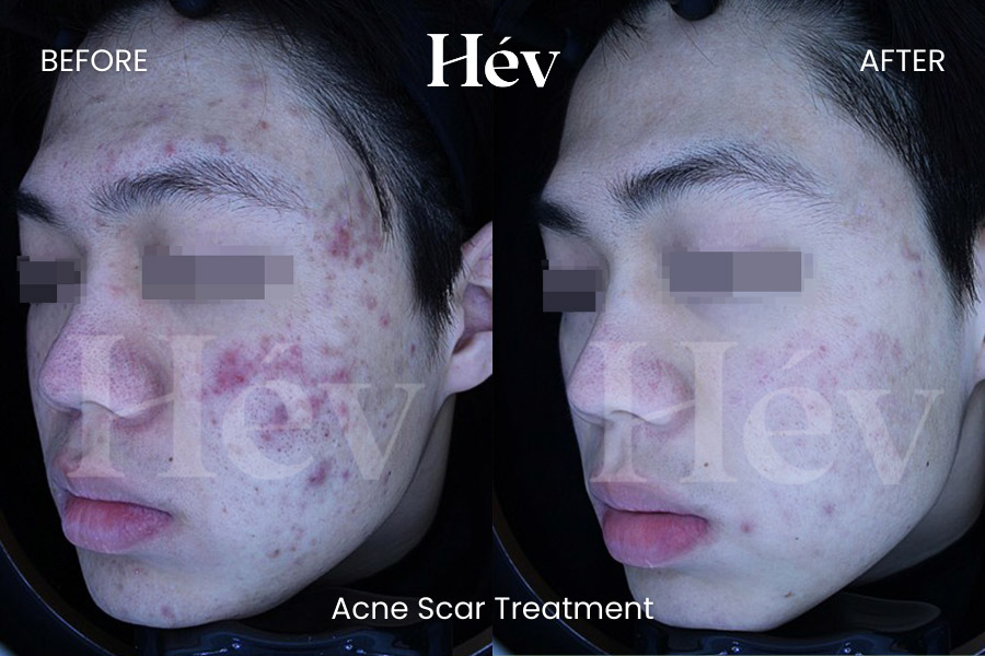 acne-scar-treatment-before and after